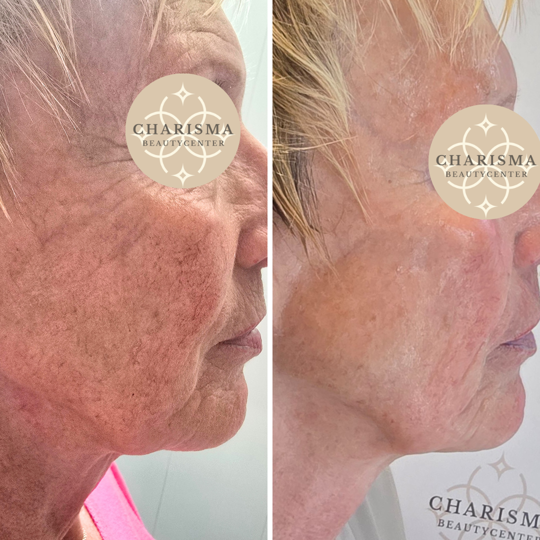 Fallstudie 3: Rosacea & Couperose - Charisma Beautycenter in Neckarsulm
